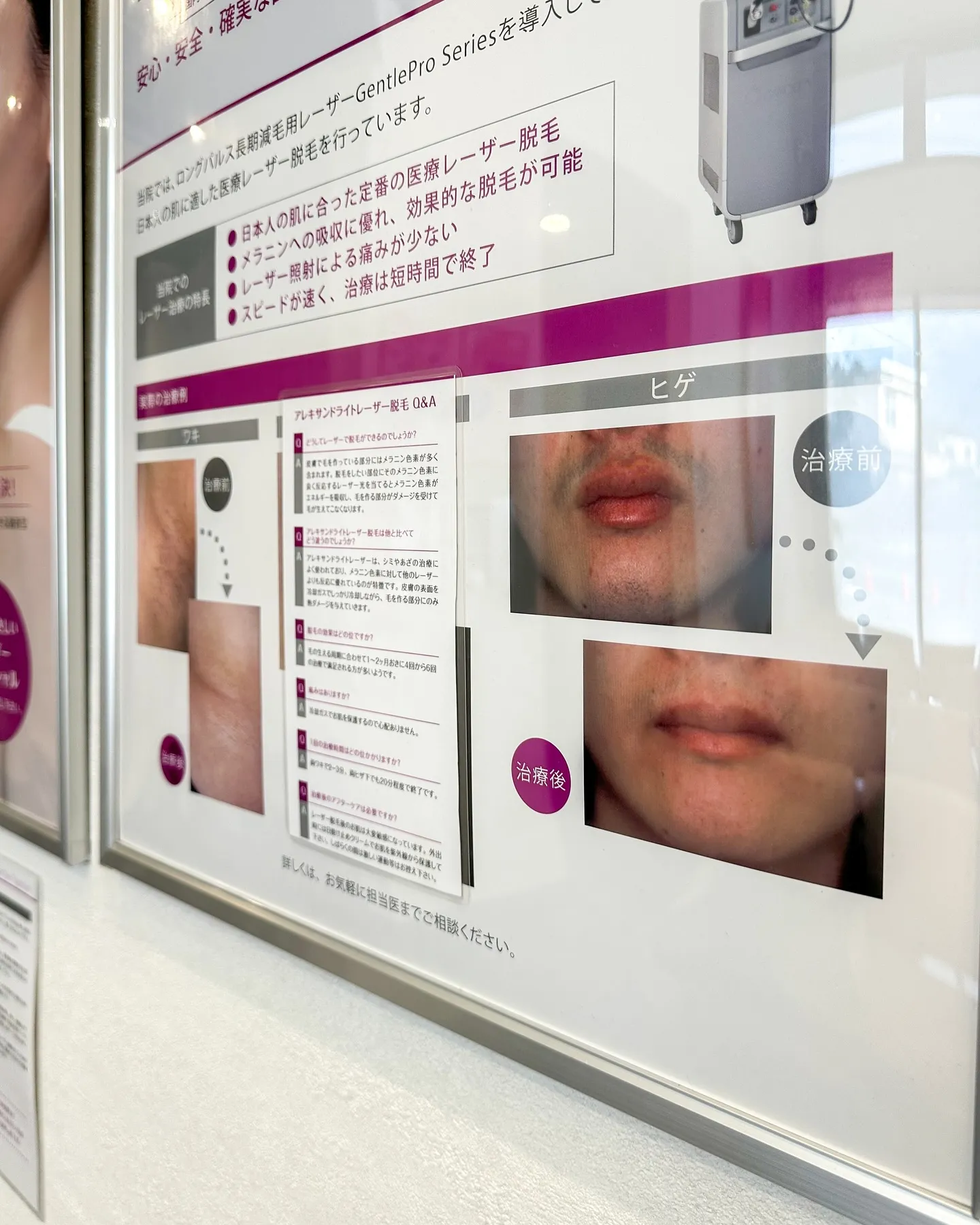 脱毛もご相談ください😉