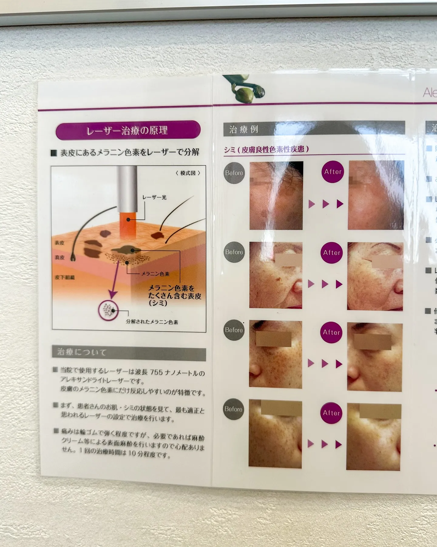 脱毛もご相談ください😉