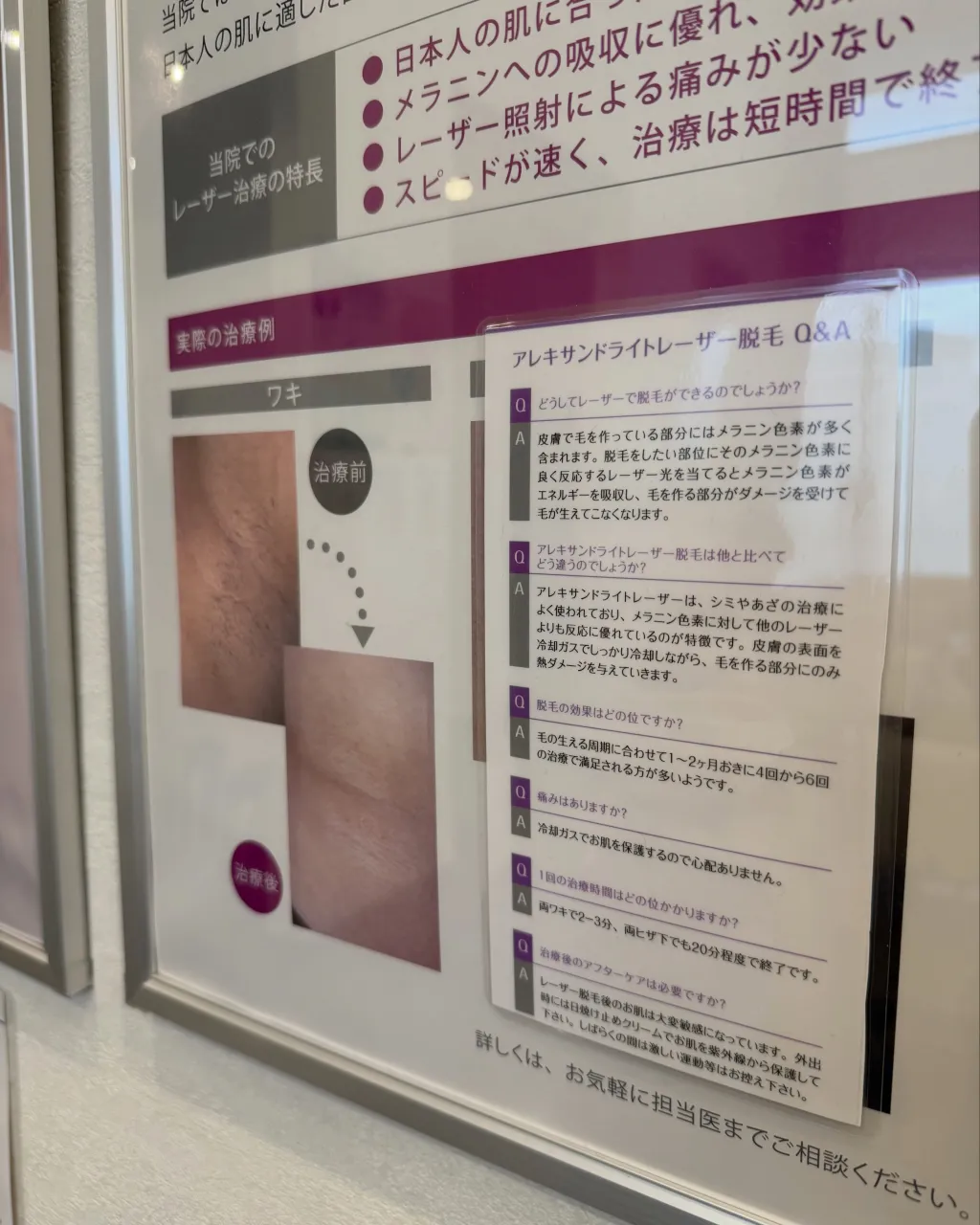 「レーザー治療ってどんなことをするの？」