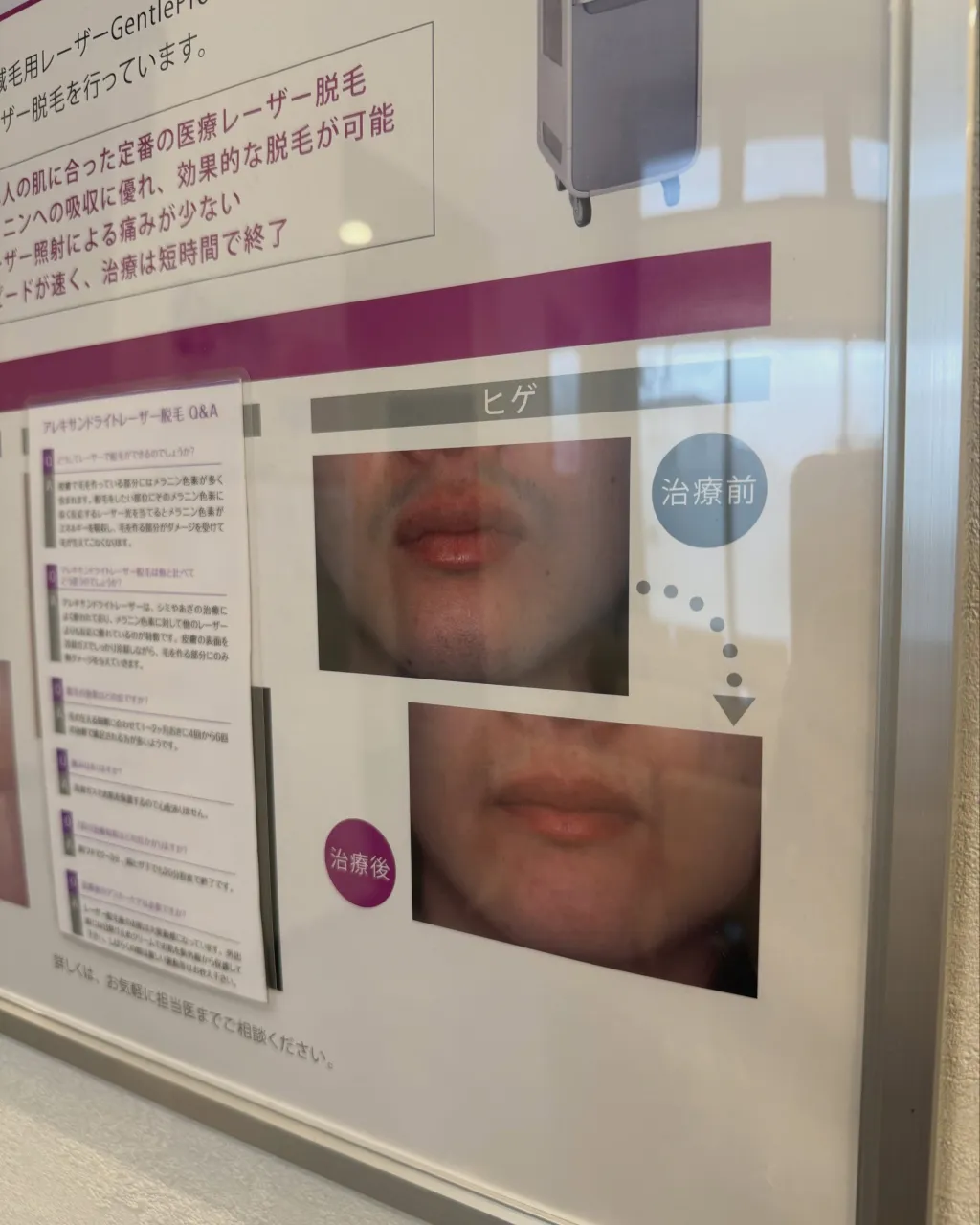 「レーザー治療ってどんなことをするの？」